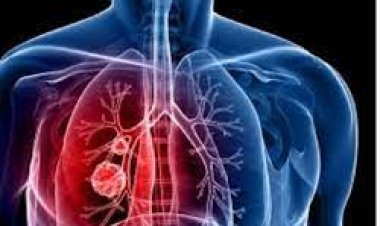 Abarwayi b'igituntu bariyongereye mu Rwanda ugereranyije n’imyaka ishize