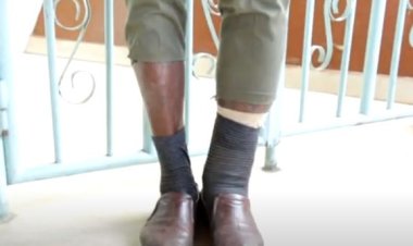 Musanze–Burera: kuvura gusa abafite indwara y’imidido ntibihagije