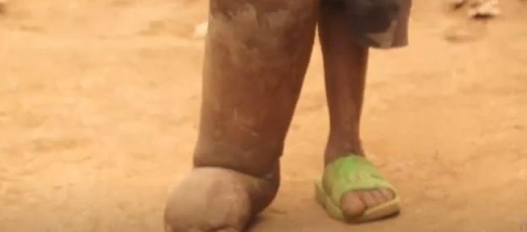 Burera: Baratabariza umwana w'imyaka 7 uri kubyimba akaguru