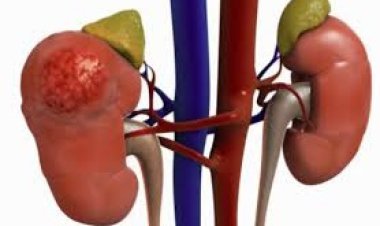 Kirehe: Barasaba gusobanurirwa uburwayi bw'impyiko