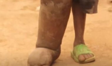 Burera: Baratabariza umwana w'imyaka 7 uri kubyimba akaguru