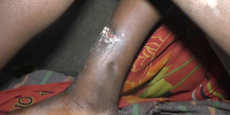 Musanze: Baratabariza umuntu watobotse umubiri usohokamo amagufwa wabuze ubushobozi bwo kwivuza