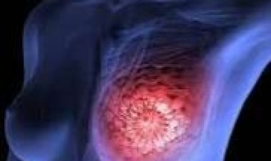 Menya kanseri 10 zibasiye Abanyarwanda